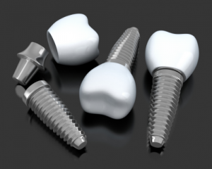 'dental implant'