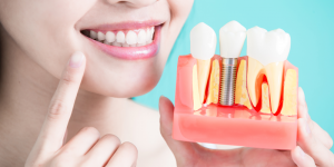 woman holding a model dental implant